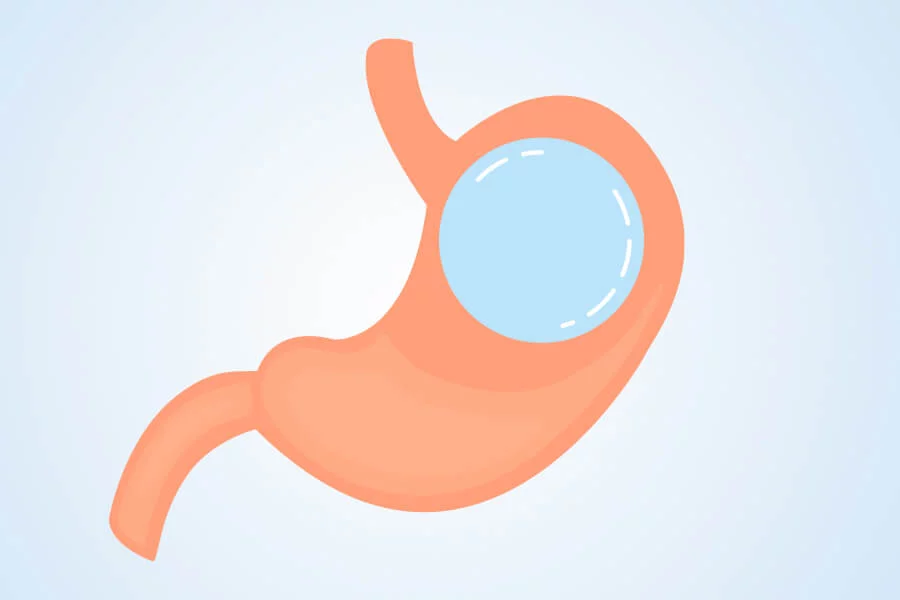 Gastric Balloon Travelmedi