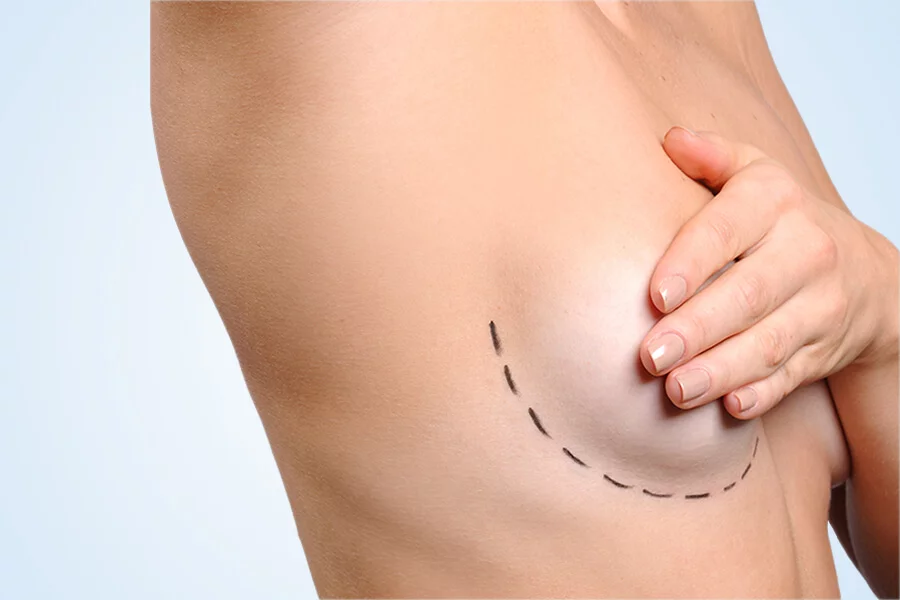 Is It Possible to Have Breast Augmentation Without Scars