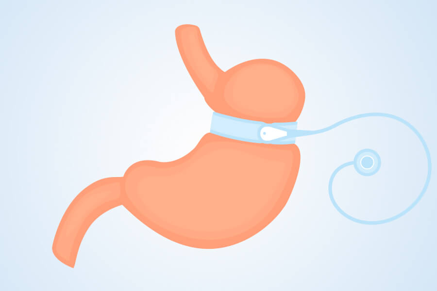 Gastric band operation details