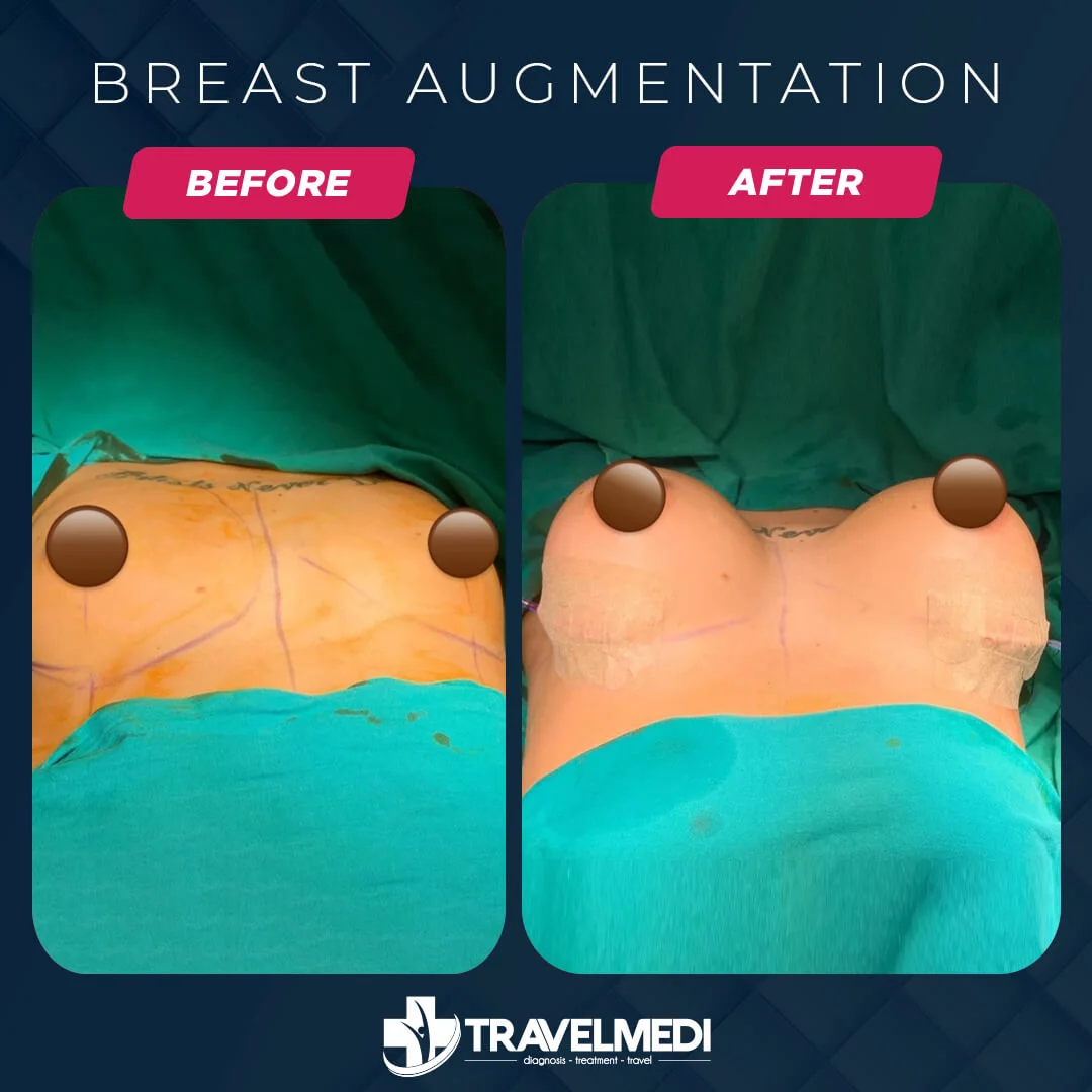 Breast Augmentation Surgery Turkey - Best Clinic and Cost 2024