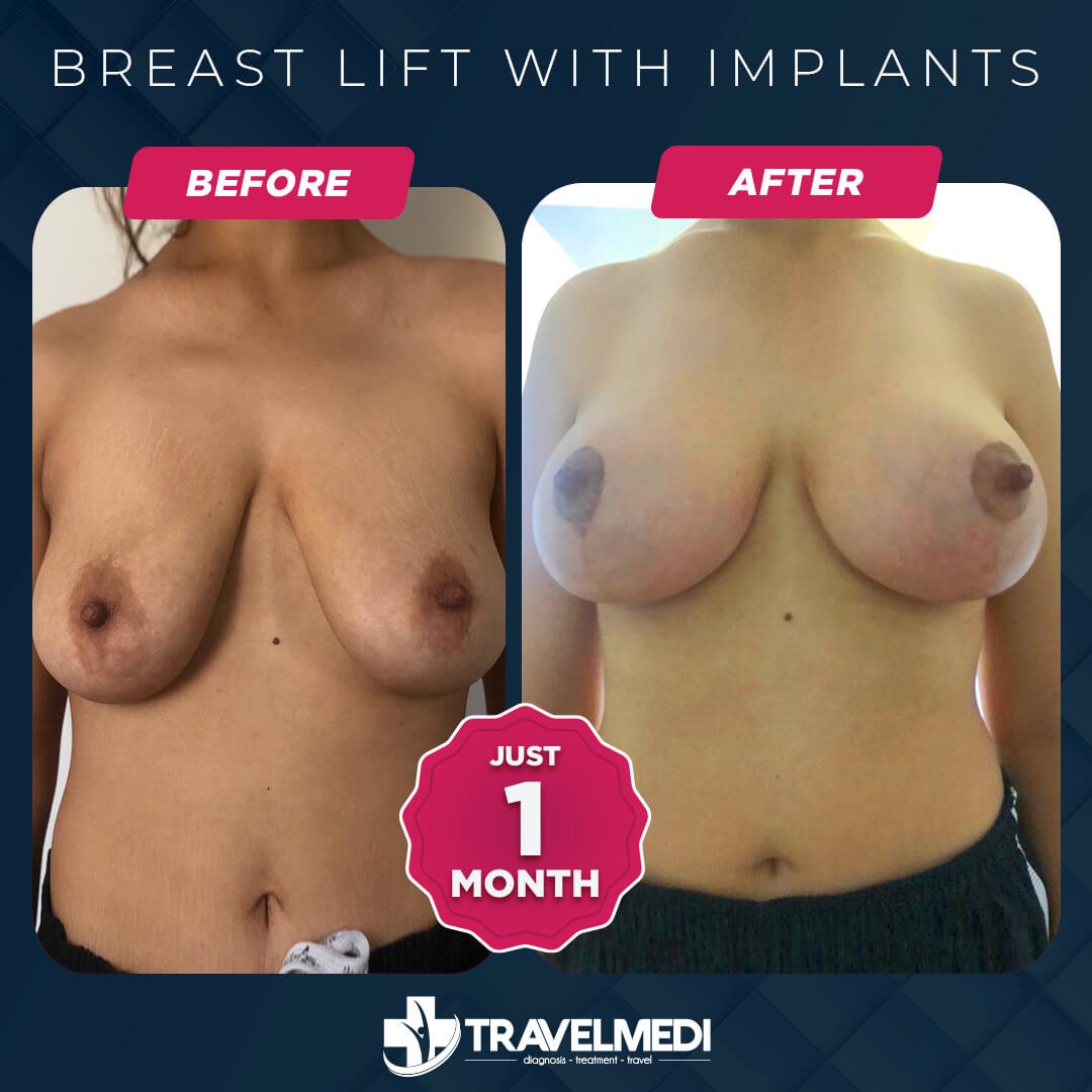 Breast Lift Turkey Before After
