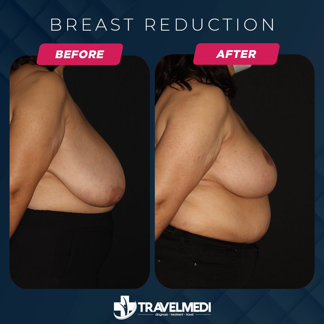 Breast reduction before after in Turkey