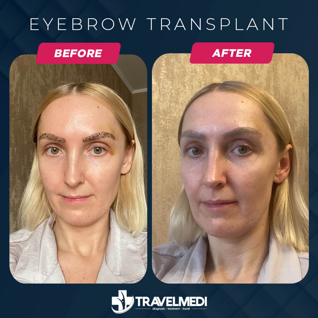 Eyebrow Transplant Turkey Before After