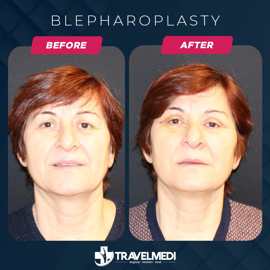 Eyelid surgery before after in Turkey