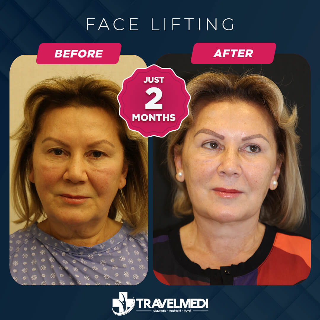 Facelift before after in Turkey