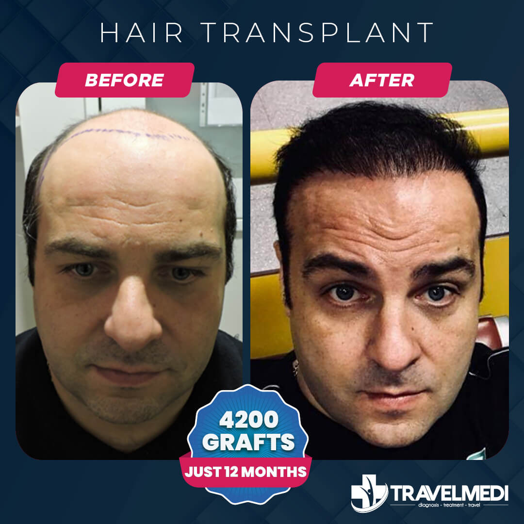 FUE Hair Transplant Turkey Results