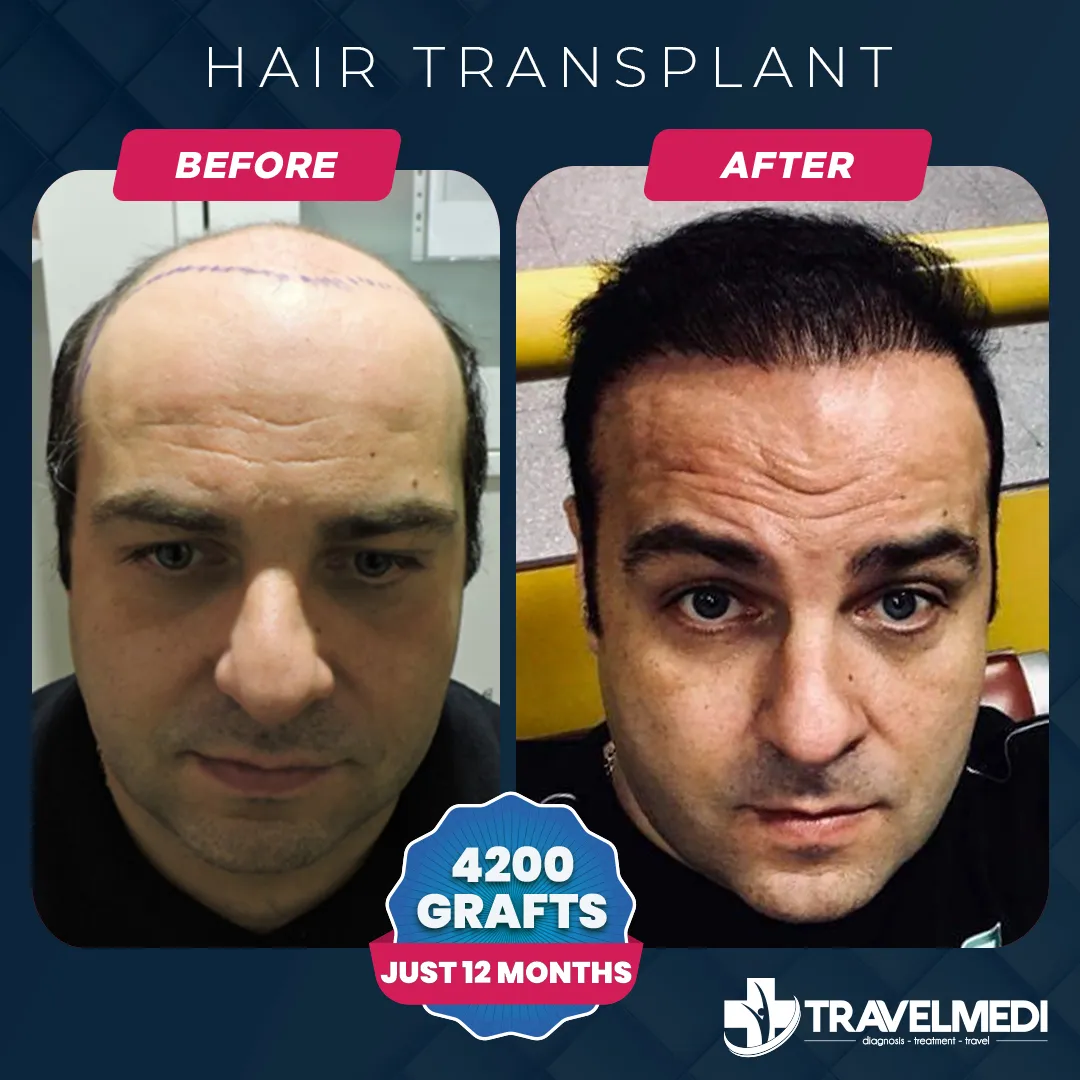 Dhi Hair Transplant Travelmedi 1706