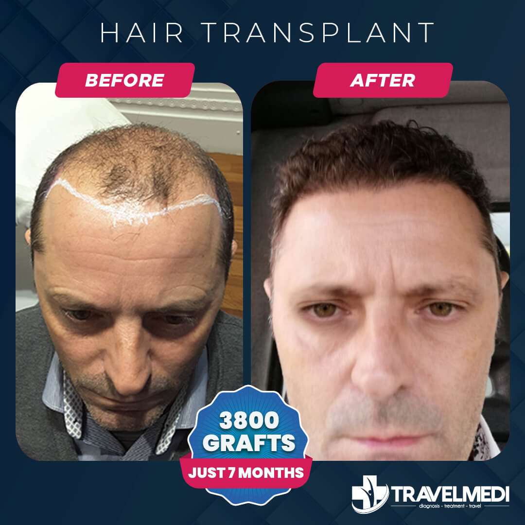 Hair Transplant Turkey Results
