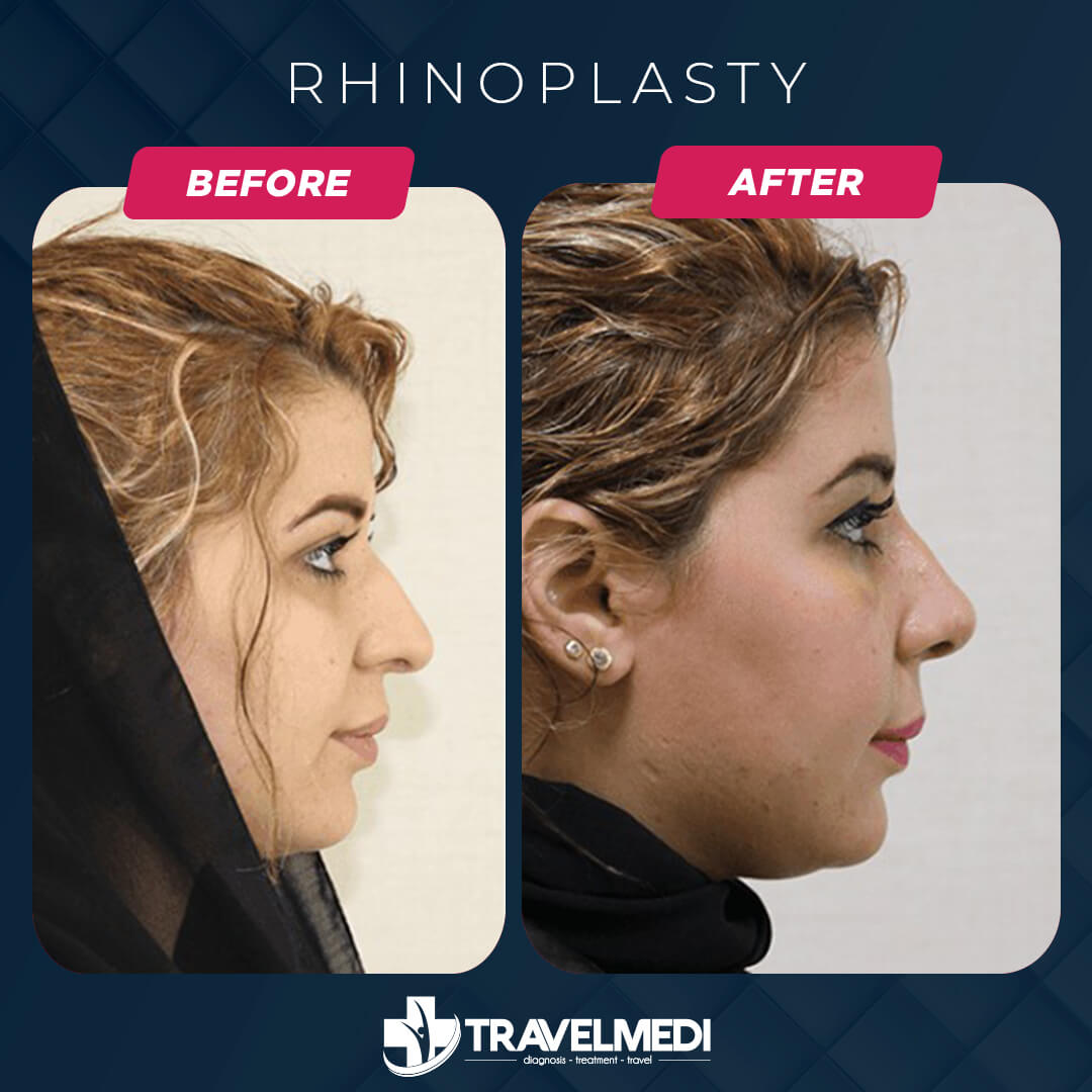 Rhinoplasty Before After in Turkey