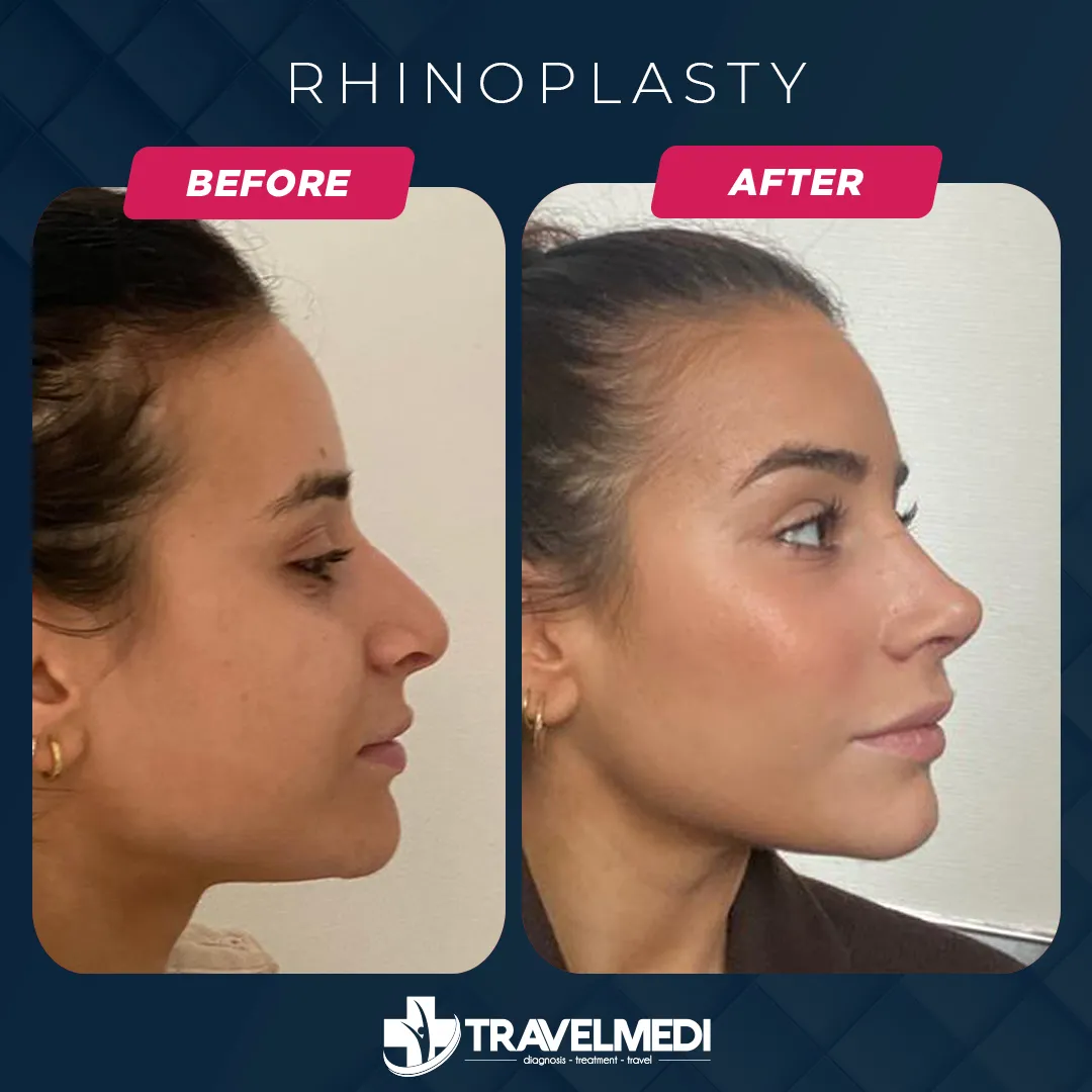 rhinoplasty-travelmedi