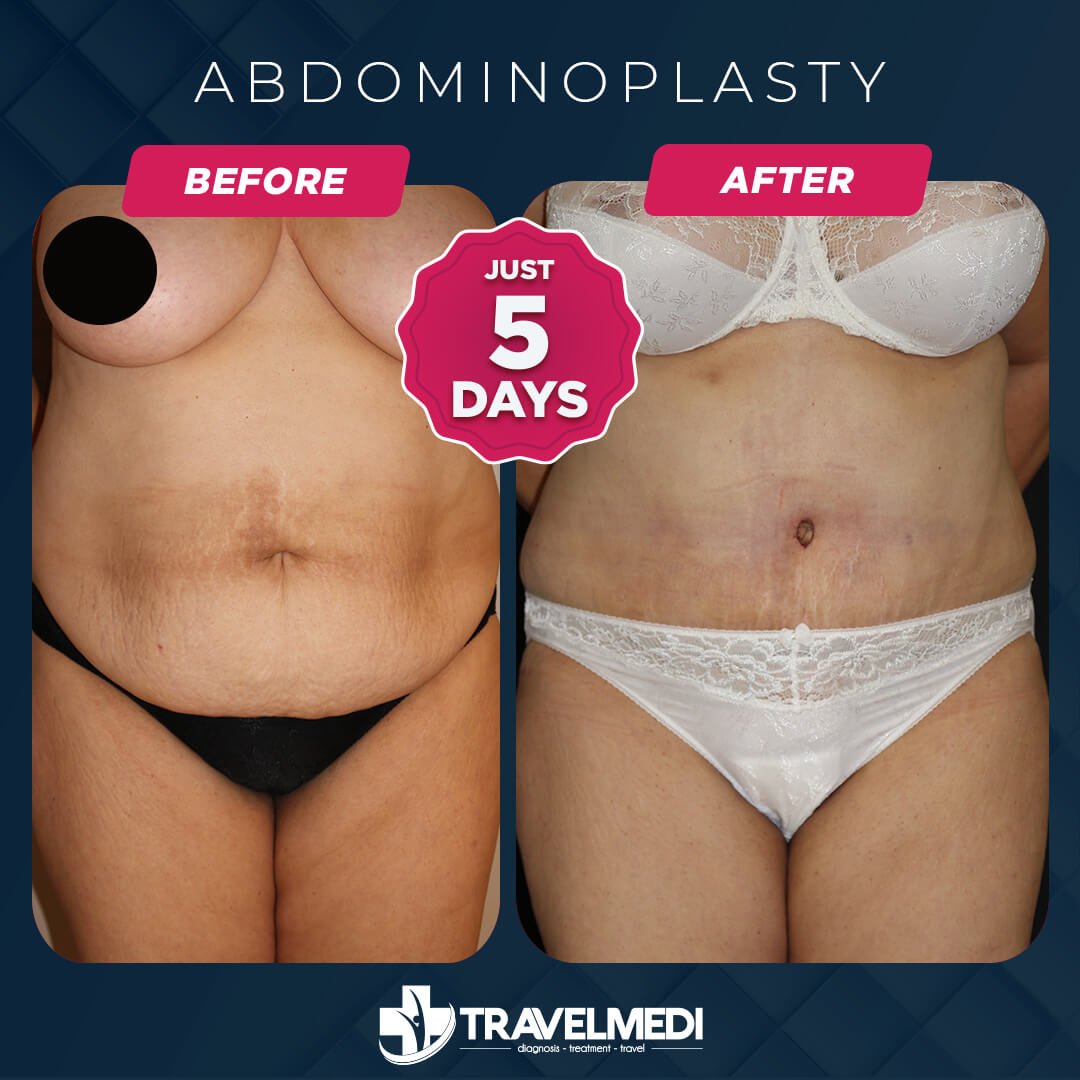 Tummy Tuck before after in Turkey