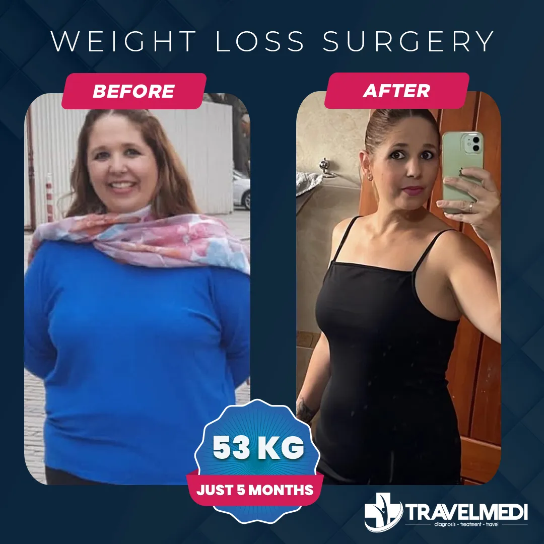 Weight loss surgery patient result after five months