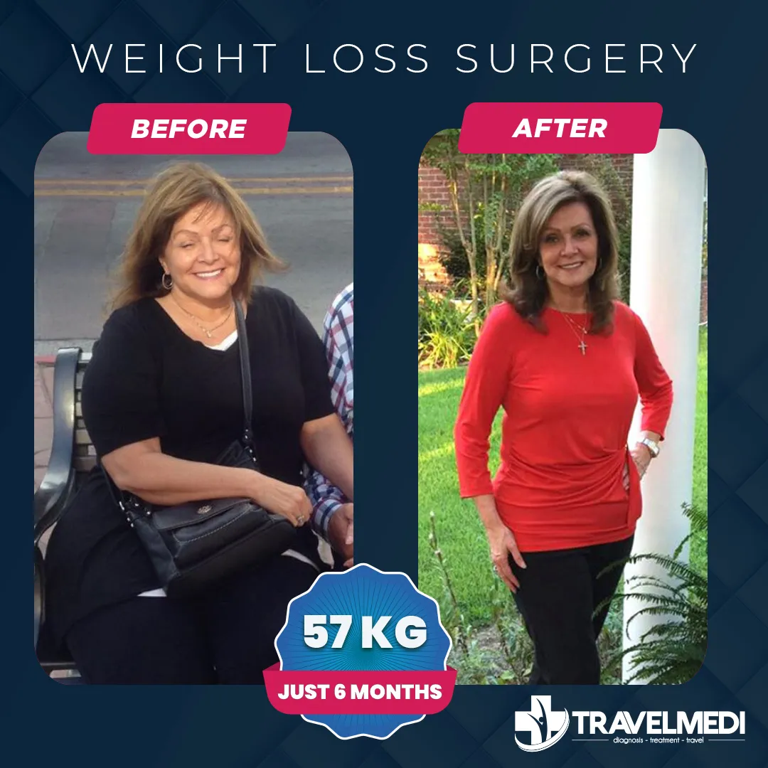 Weight loss surgery patient result after six months