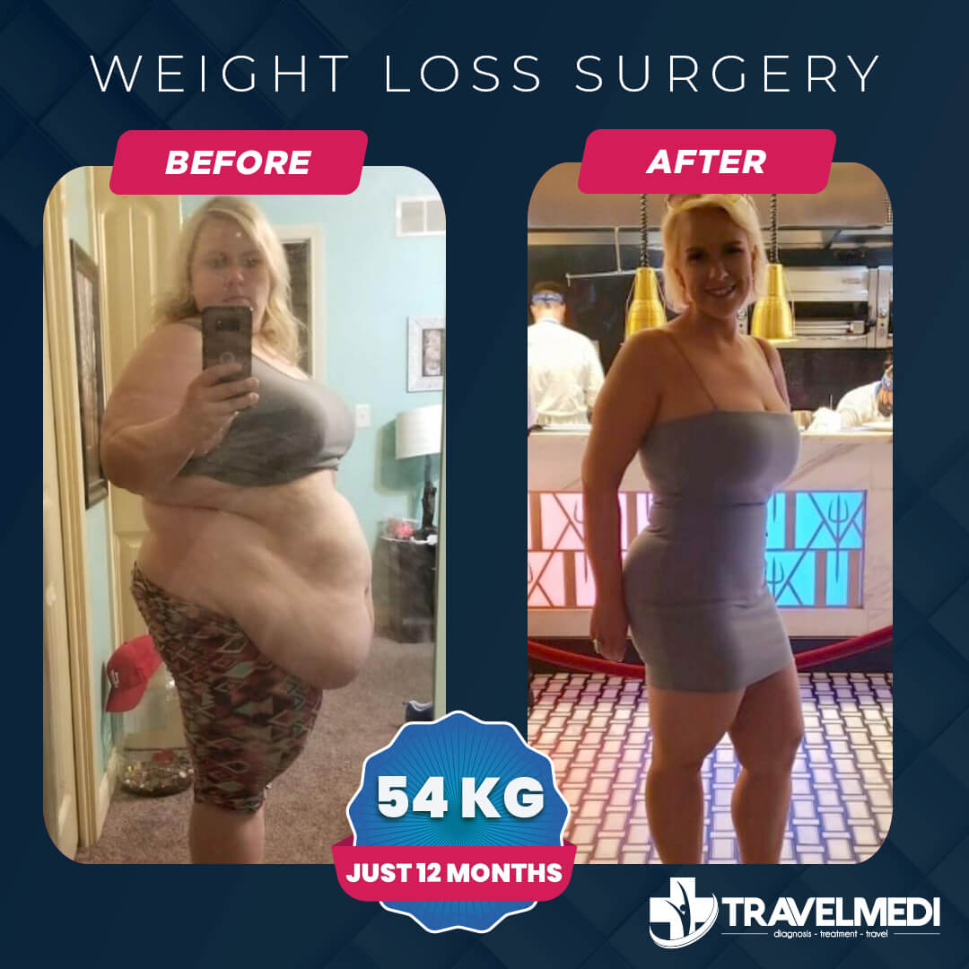 Weight loss surgery before after in Turkey