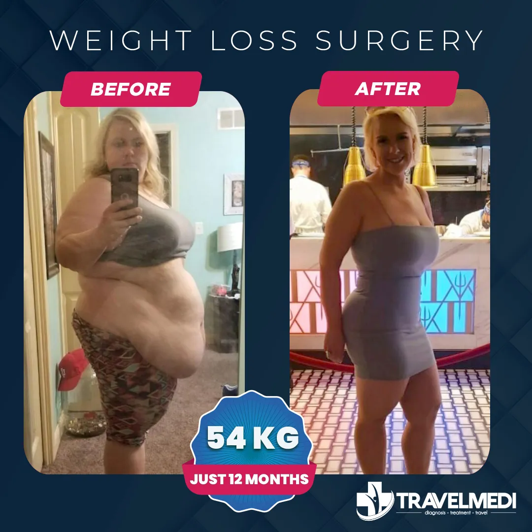 Weight loss surgery patient result after twelve months