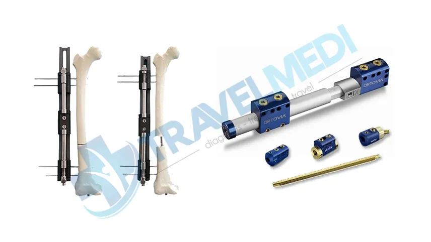 The LON Method for limb lengthening surgery