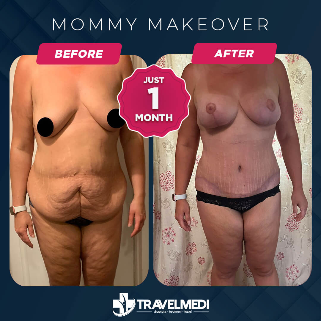 Mommy Makeover before after in Turkey